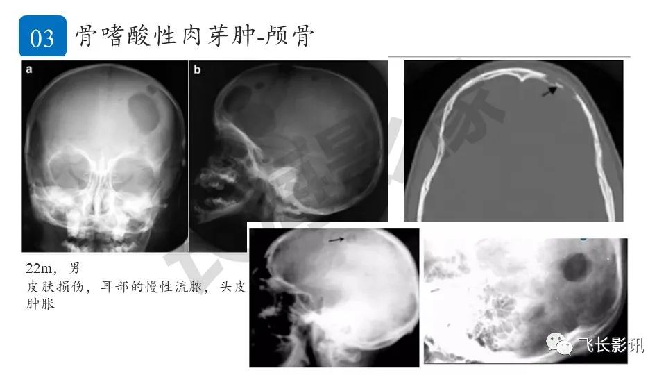 【PPT】骨嗜酸性肉芽肿-11