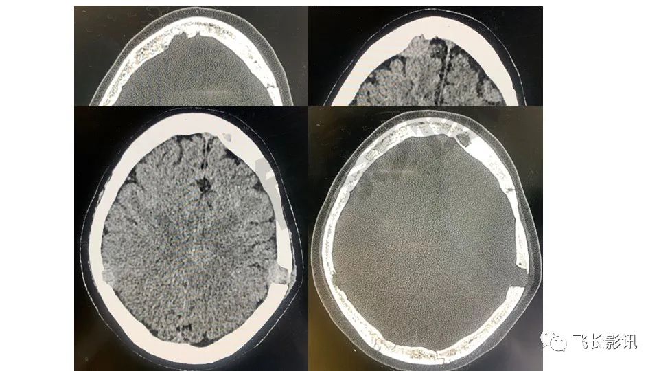 【PPT】骨嗜酸性肉芽肿-16