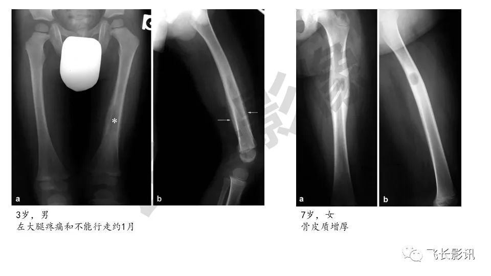 【PPT】骨嗜酸性肉芽肿-29
