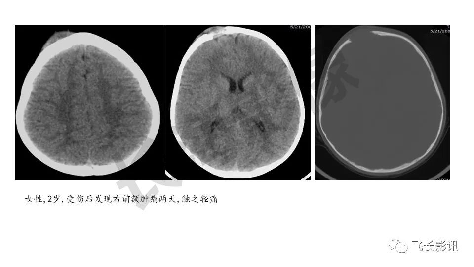 【PPT】骨嗜酸性肉芽肿-17