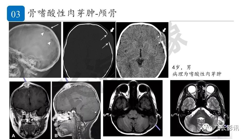 【PPT】骨嗜酸性肉芽肿-12