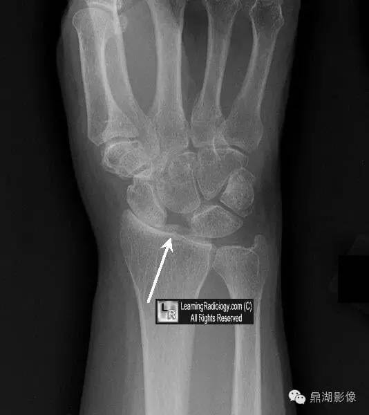 发生在腕关节的“稀疏牙缝征”-4 发生在腕关节的“稀疏牙缝征”-4