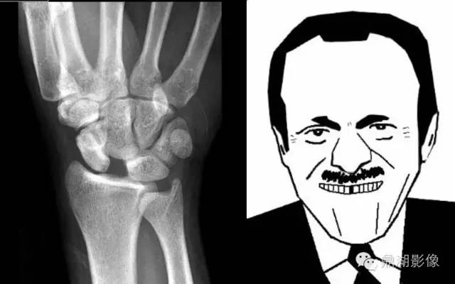 发生在腕关节的“稀疏牙缝征”-5 发生在腕关节的“稀疏牙缝征”-5