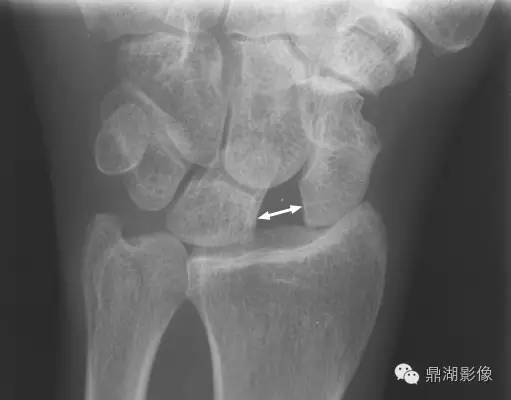 发生在腕关节的“稀疏牙缝征”-3 发生在腕关节的“稀疏牙缝征”-3