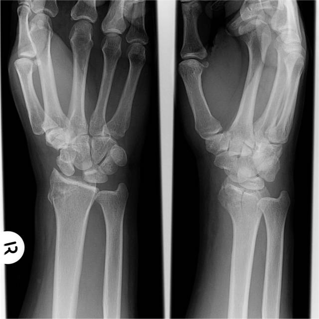 发生在腕关节的“稀疏牙缝征”-2 发生在腕关节的“稀疏牙缝征”-2