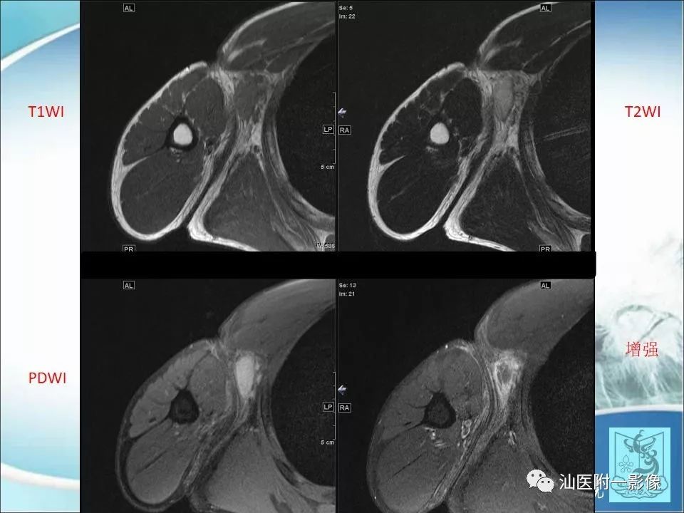 【病例】猫抓病1例MR影像-3