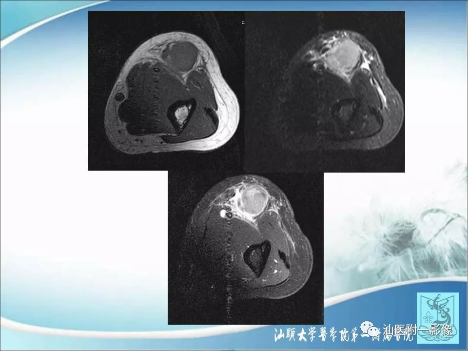 【病例】猫抓病1例MR影像-12