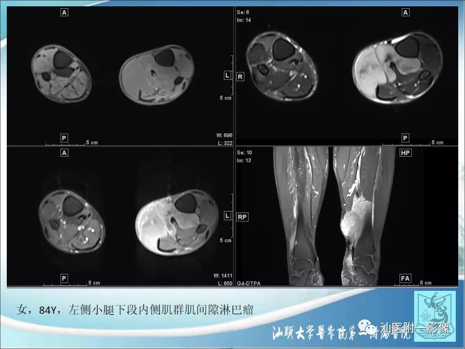 【病例】猫抓病1例MR影像-20