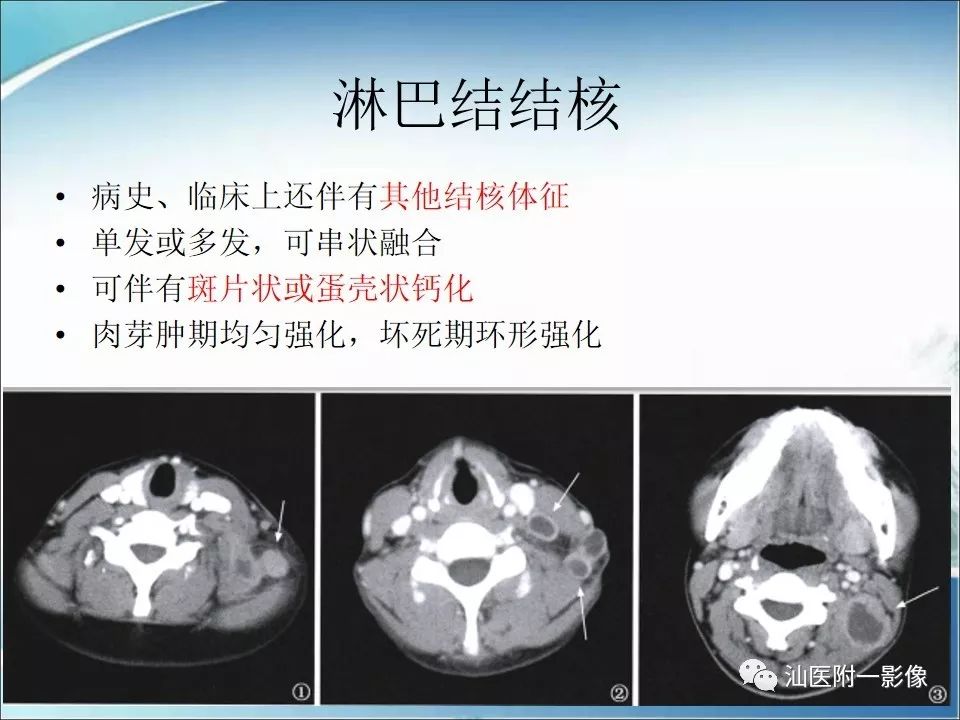 【病例】猫抓病1例MR影像-15