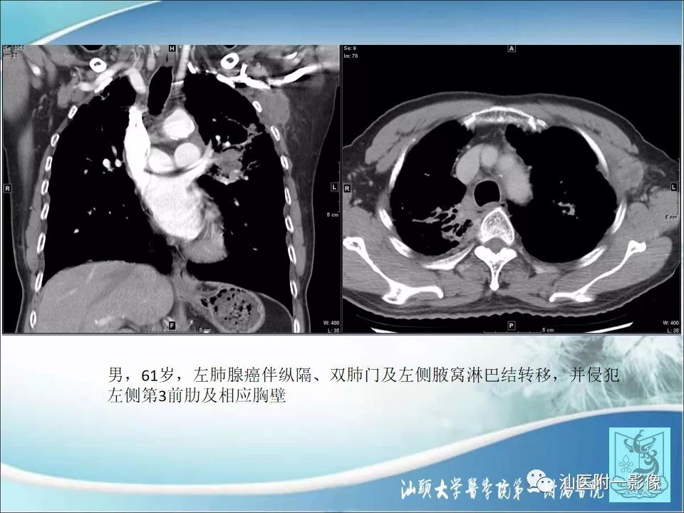 【病例】猫抓病1例MR影像-22