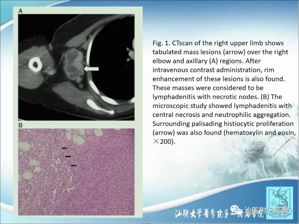 【病例】猫抓病1例MR影像-13