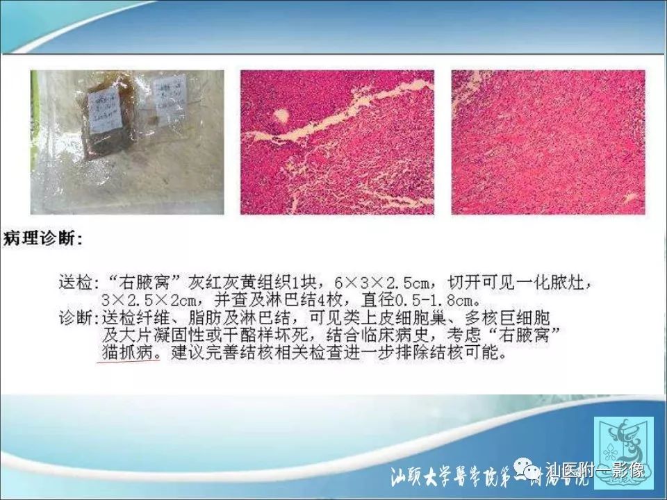 【病例】猫抓病1例MR影像-7