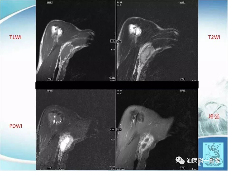 【病例】猫抓病1例MR影像-5