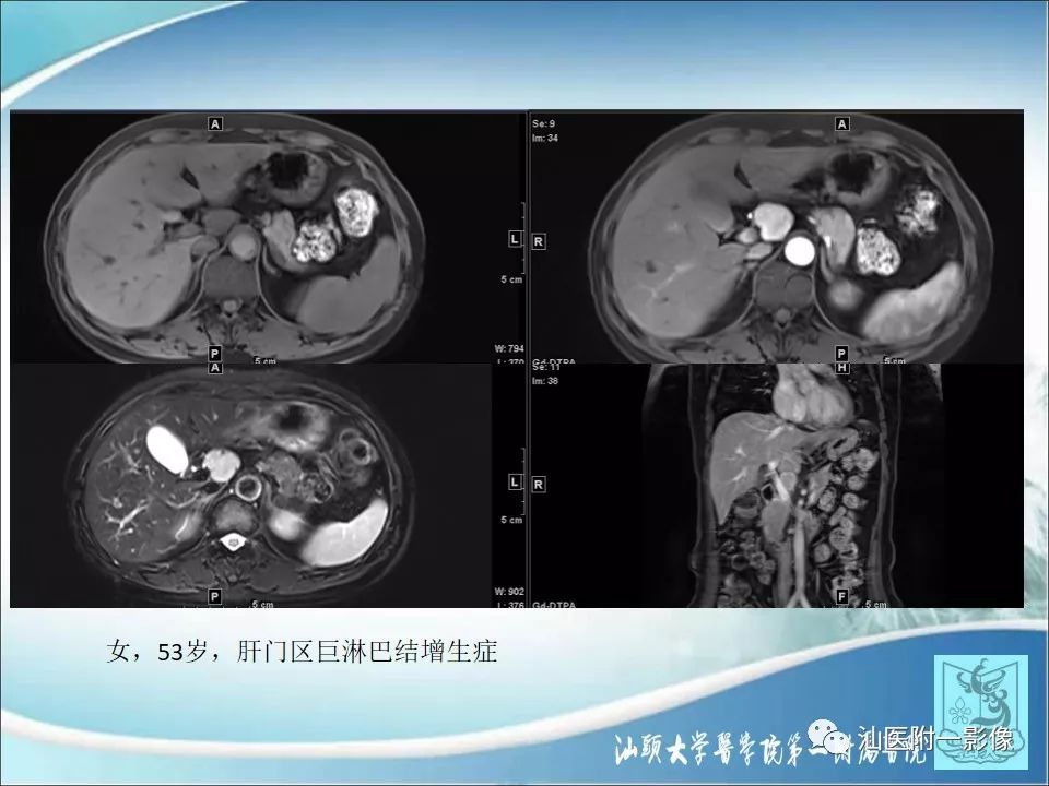 【病例】猫抓病1例MR影像-18