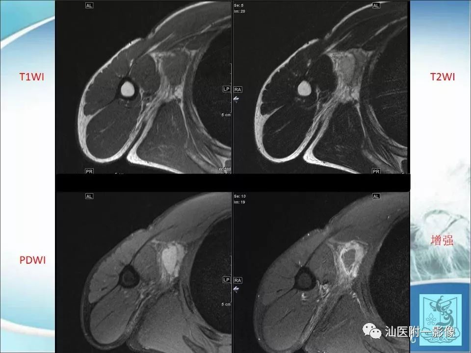 【病例】猫抓病1例MR影像-4