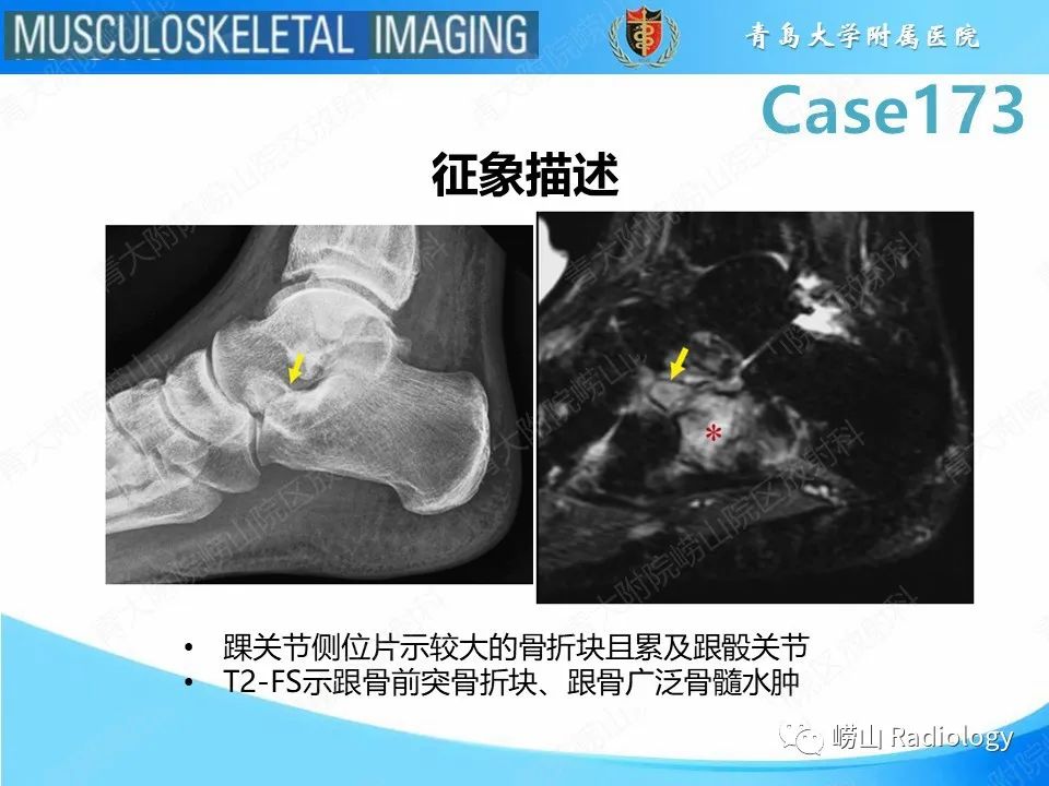 【PPT】跟骨前突骨折-24