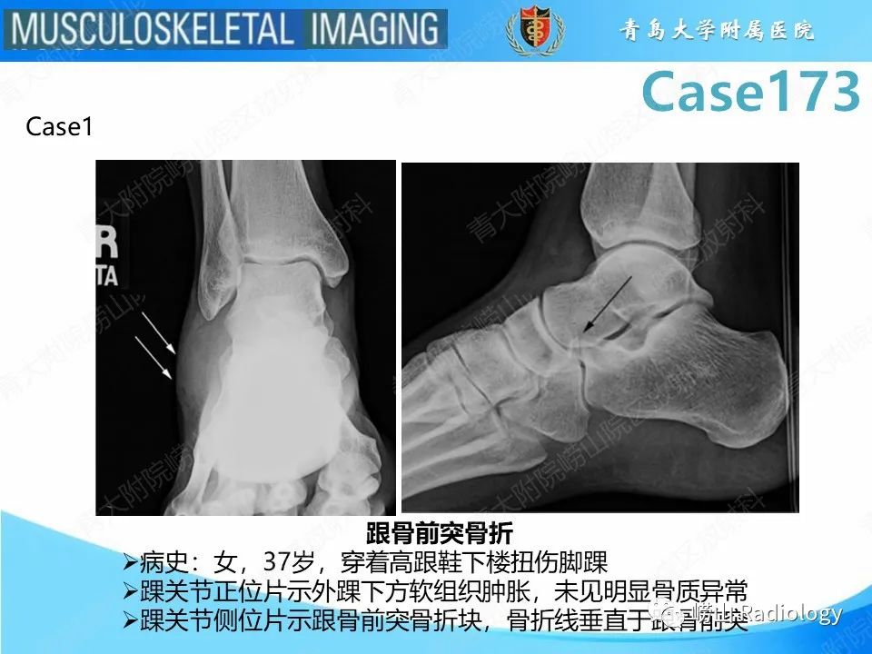 【PPT】跟骨前突骨折-17