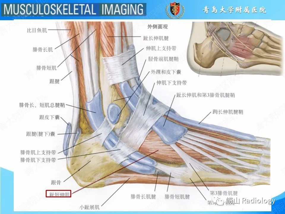 【PPT】跟骨前突骨折-14