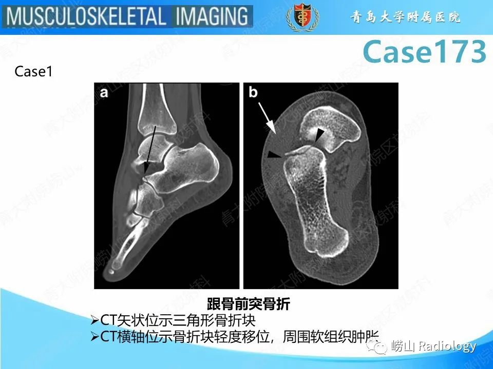 【PPT】跟骨前突骨折-18