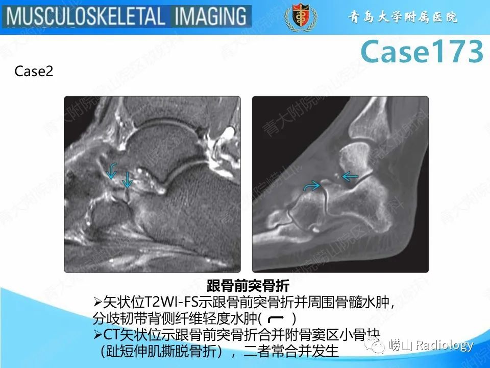 【PPT】跟骨前突骨折-20