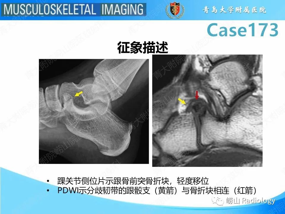【PPT】跟骨前突骨折-23