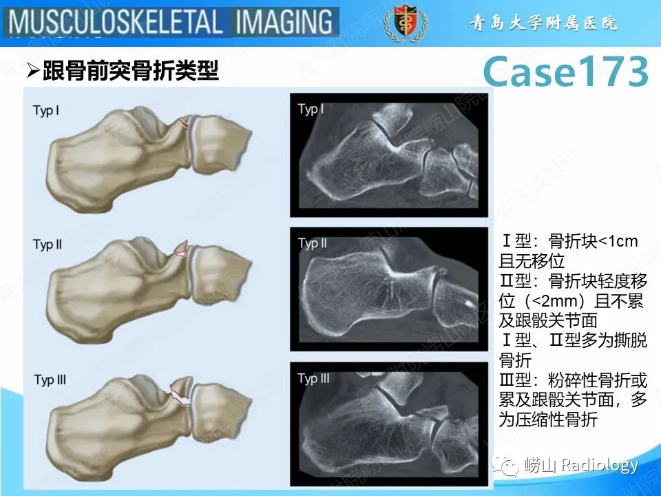 【PPT】跟骨前突骨折-16