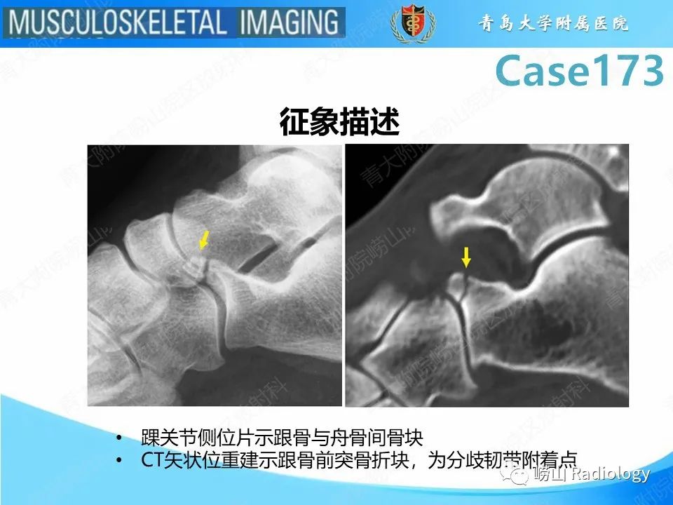 【PPT】跟骨前突骨折-22