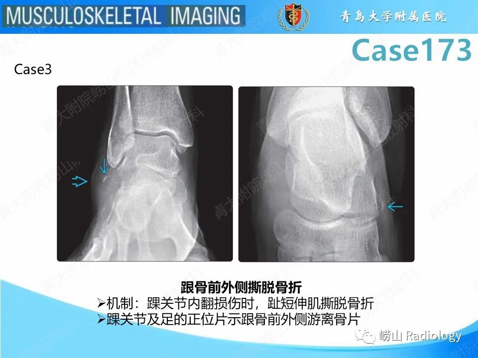 【PPT】跟骨前突骨折-21