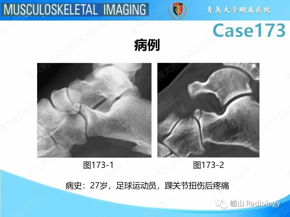 【PPT】跟骨前突骨折-2
