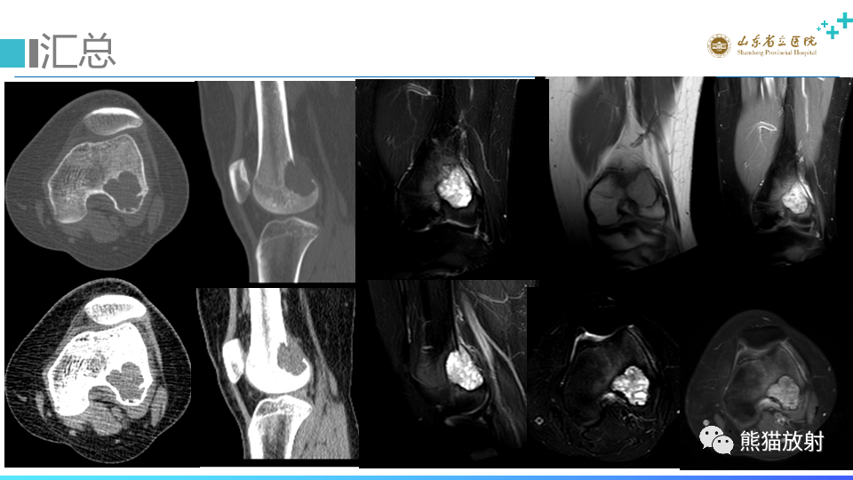 【病例】股骨远端动脉瘤样骨囊肿ABC VS 软骨母细胞瘤-4