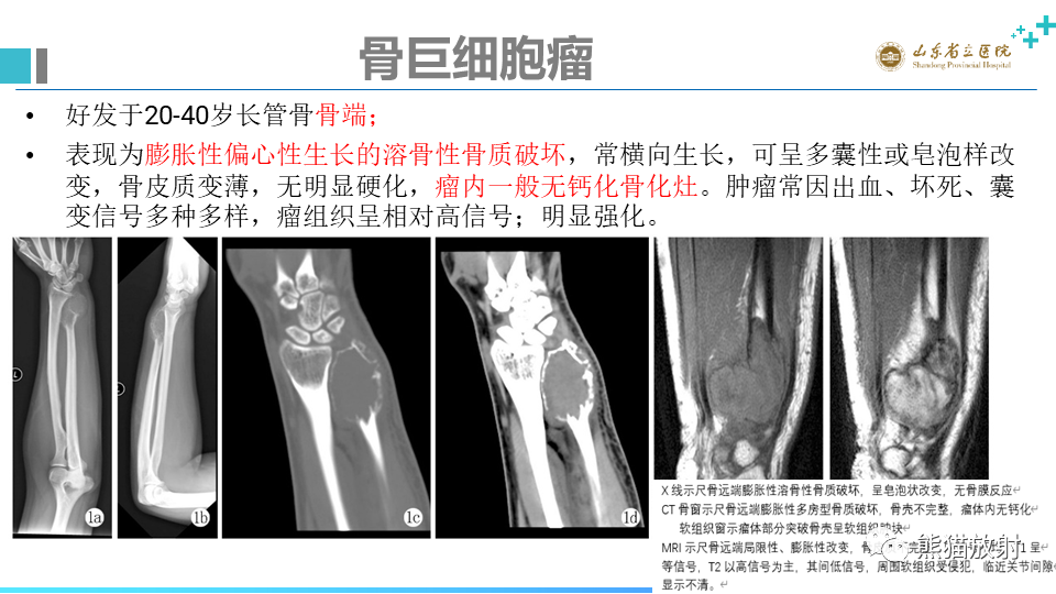 【病例】股骨远端动脉瘤样骨囊肿ABC VS 软骨母细胞瘤-16