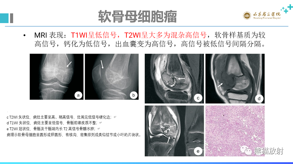 【病例】股骨远端动脉瘤样骨囊肿ABC VS 软骨母细胞瘤-14