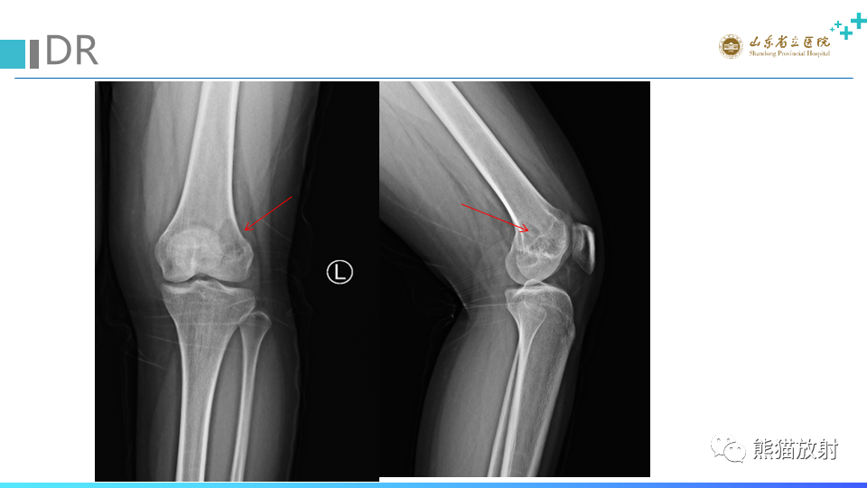 【病例】股骨远端动脉瘤样骨囊肿ABC VS 软骨母细胞瘤-3