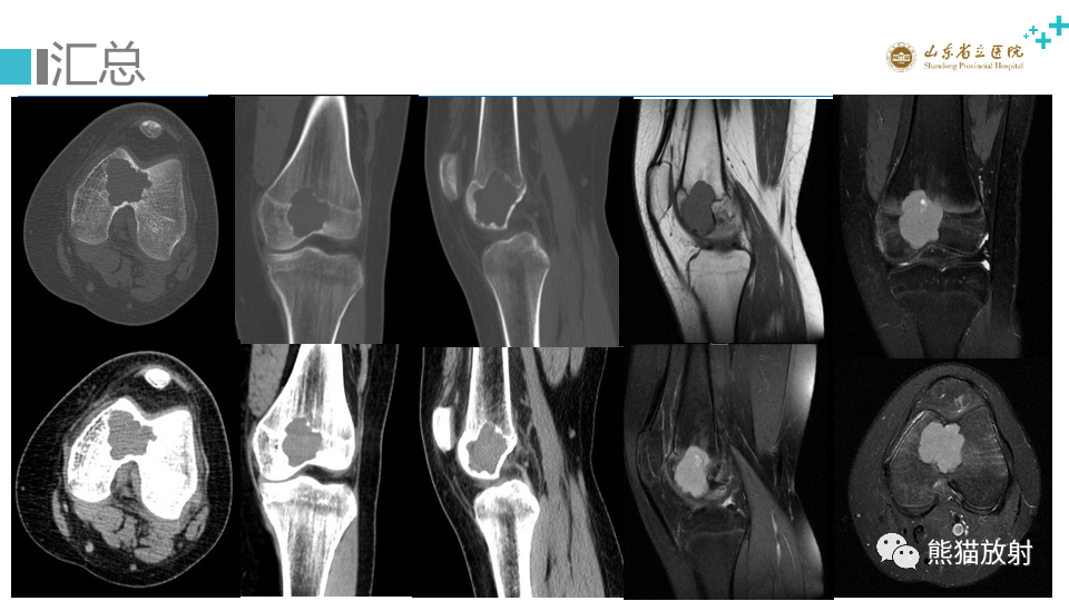 【病例】股骨远端动脉瘤样骨囊肿ABC VS 软骨母细胞瘤-8