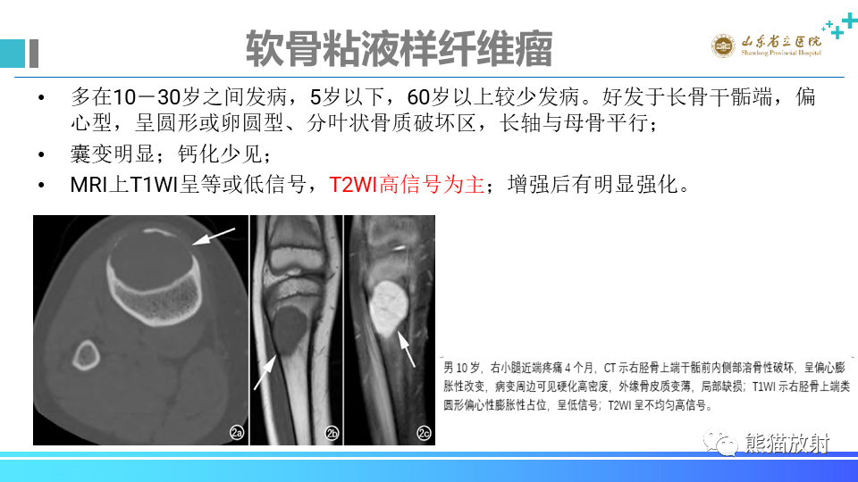 【病例】股骨远端动脉瘤样骨囊肿ABC VS 软骨母细胞瘤-19