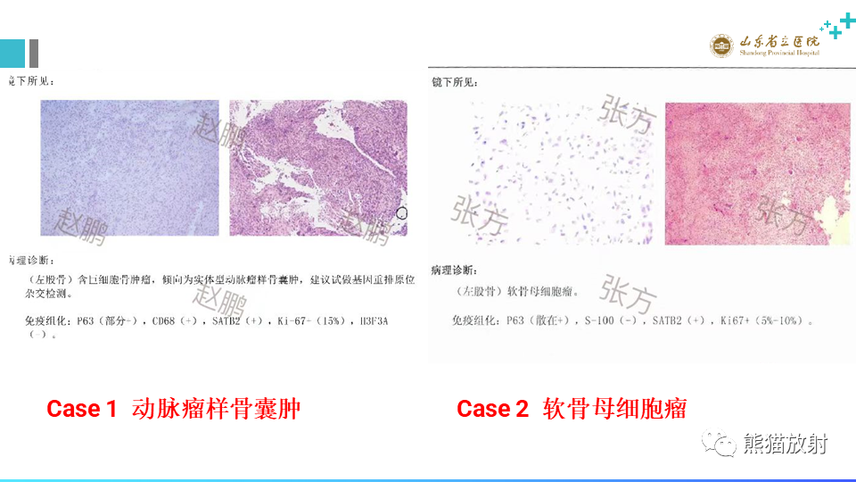 【病例】股骨远端动脉瘤样骨囊肿ABC VS 软骨母细胞瘤-10