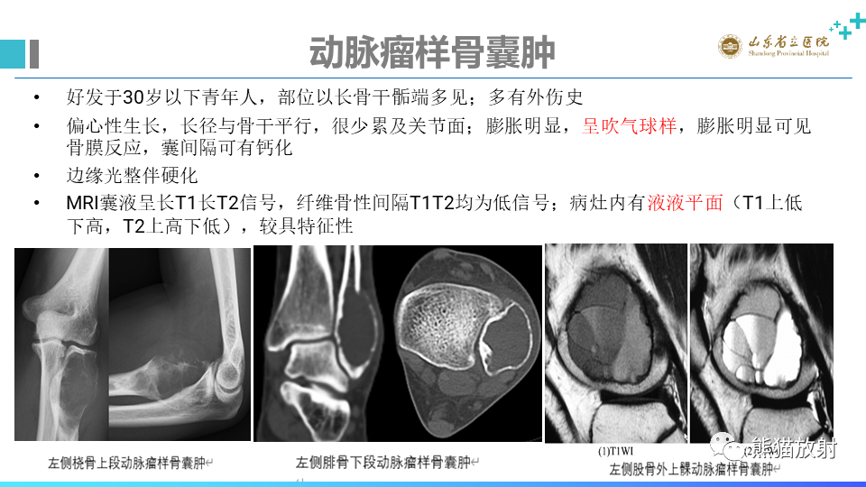 【病例】股骨远端动脉瘤样骨囊肿ABC VS 软骨母细胞瘤-17