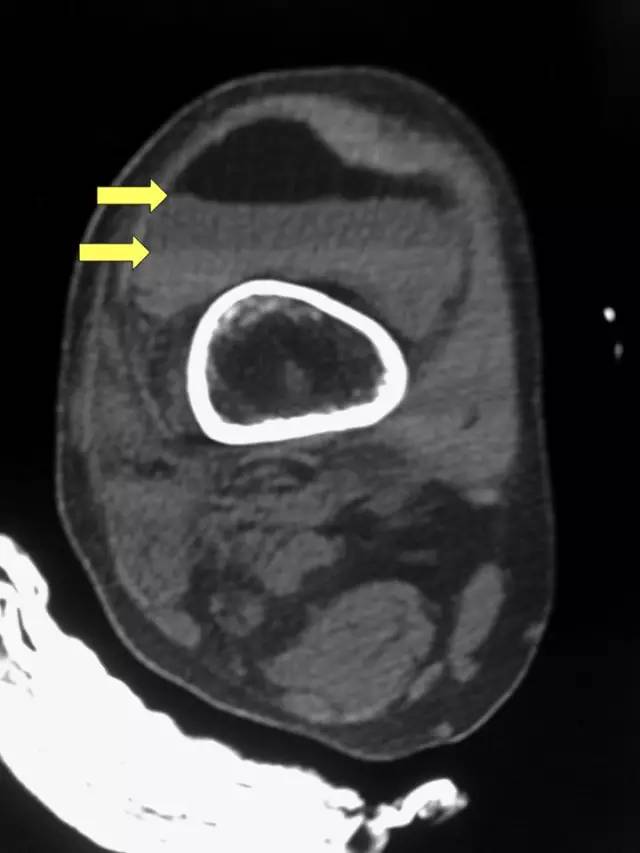 膝关节出现“FBI征”,要小心合并骨折-4 膝关节出现“FBI征”,要小心合并骨折-4