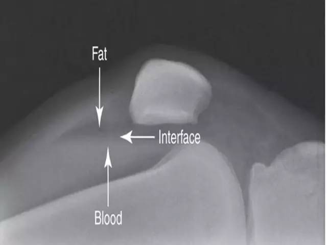 膝关节出现“FBI征”,要小心合并骨折-2 膝关节出现“FBI征”,要小心合并骨折-2