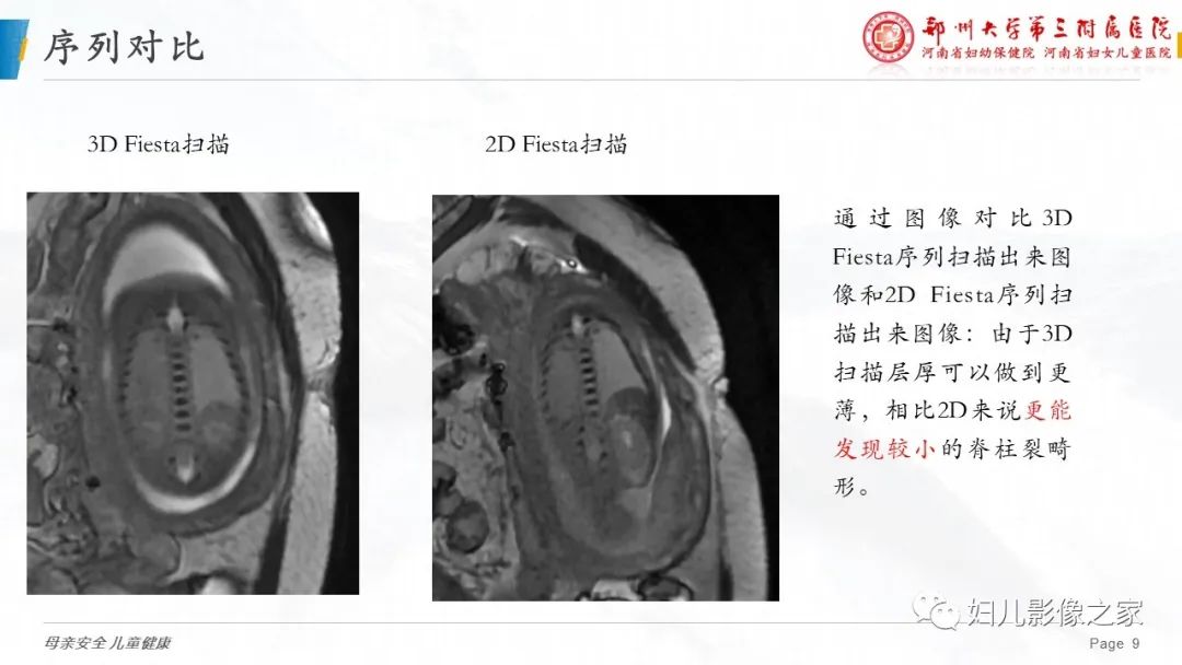 【PPT】3D fiesta序列在胎儿脊柱中的应用-9