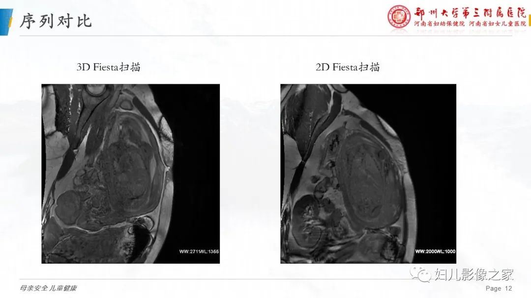 【PPT】3D fiesta序列在胎儿脊柱中的应用-12