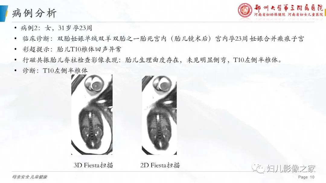 【PPT】3D fiesta序列在胎儿脊柱中的应用-10