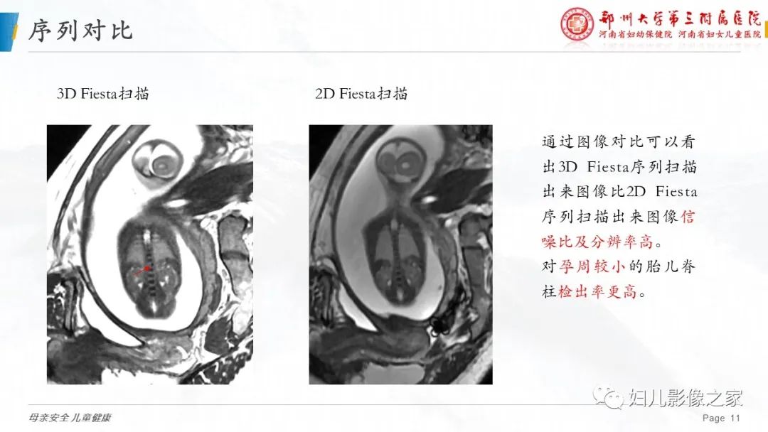【PPT】3D fiesta序列在胎儿脊柱中的应用-11