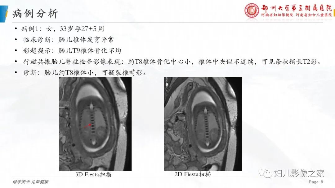 【PPT】3D fiesta序列在胎儿脊柱中的应用-8