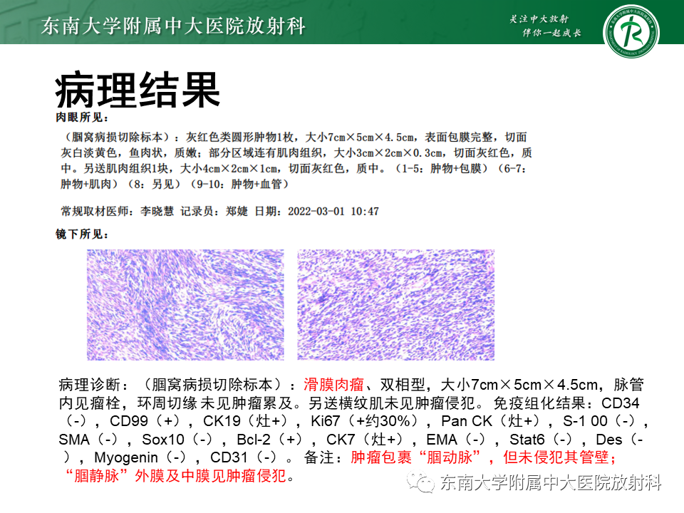 【PPT】膝关节腱鞘巨细胞瘤-34 【PPT】膝关节腱鞘巨细胞瘤-34