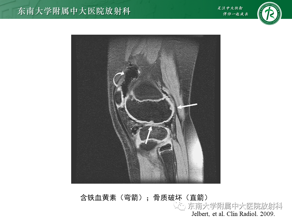 【PPT】膝关节腱鞘巨细胞瘤-36 【PPT】膝关节腱鞘巨细胞瘤-36