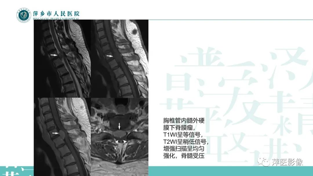 【PPT】髓外硬膜内肿瘤-10