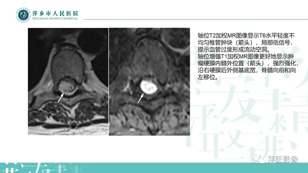 【PPT】髓外硬膜内肿瘤-25