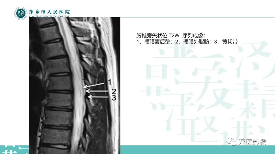 【PPT】髓外硬膜内肿瘤-6
