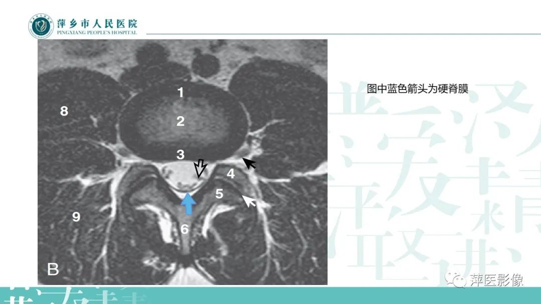 【PPT】髓外硬膜内肿瘤-7